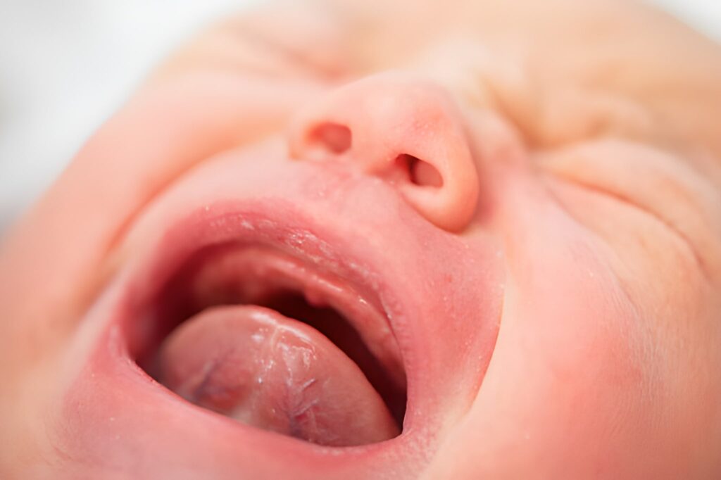 Tongue Tie and Lip Tie in Babies: Ottawa Kids Dentistry Guide 7 Tongue Tie and Lip Tie in Babies Ottawa Kids Dentistry