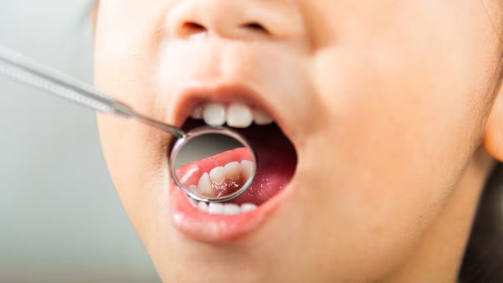 How to Prevent Cavities in Toddlers 2 Cavities in Toddlers