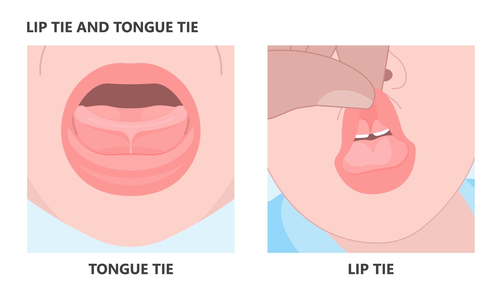 What Is the Difference Between Lip Tie and Tongue Tie